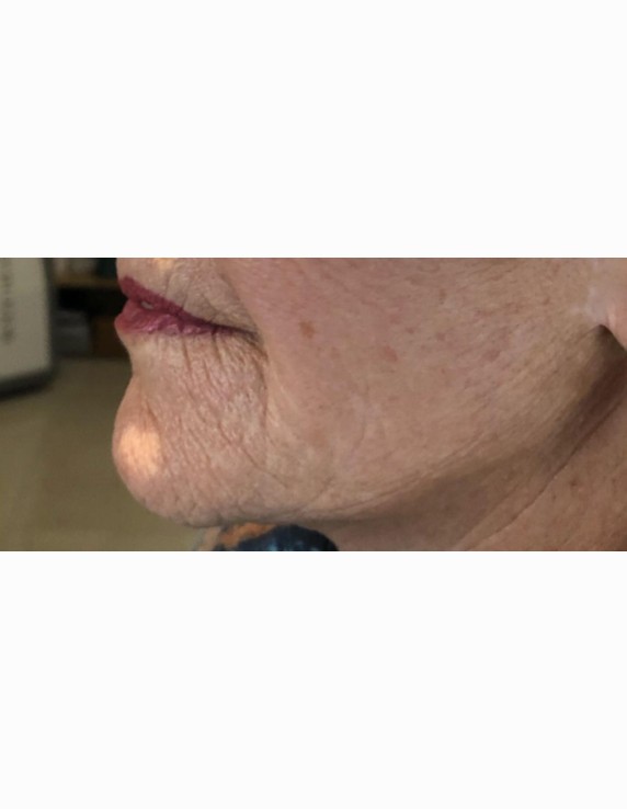 chin-after-w