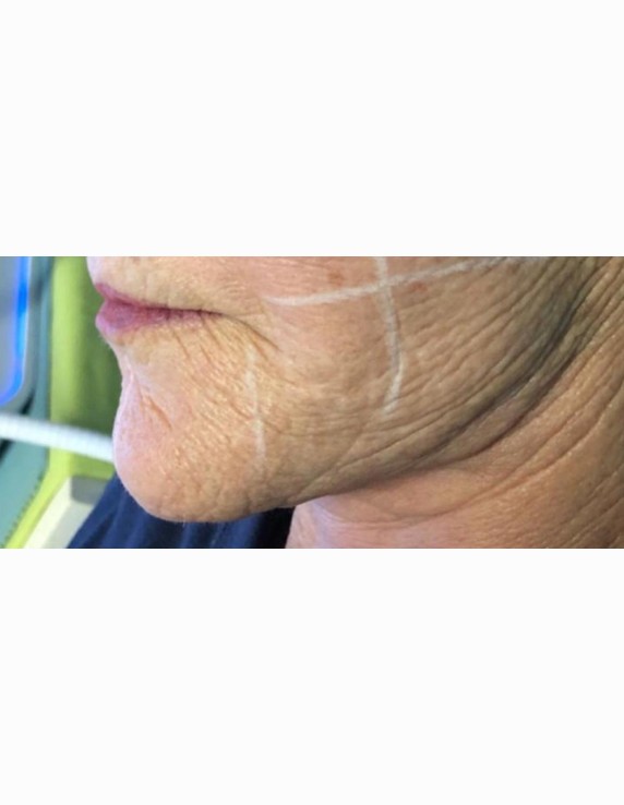 chin-before-w