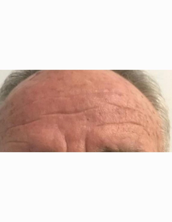 forehead-after-w
