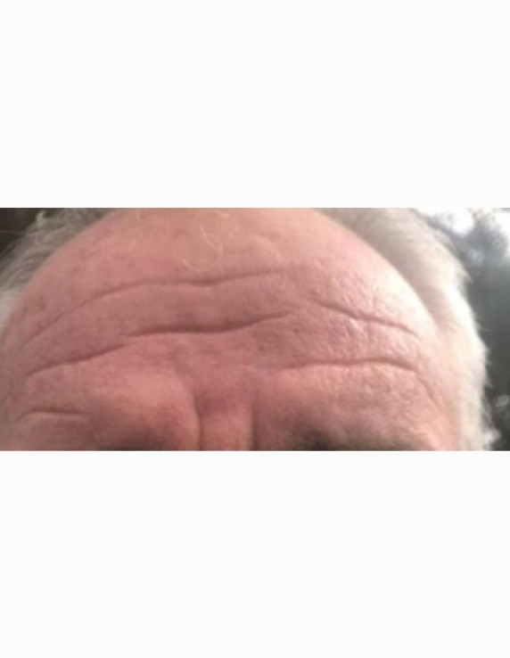 forehead-before-w