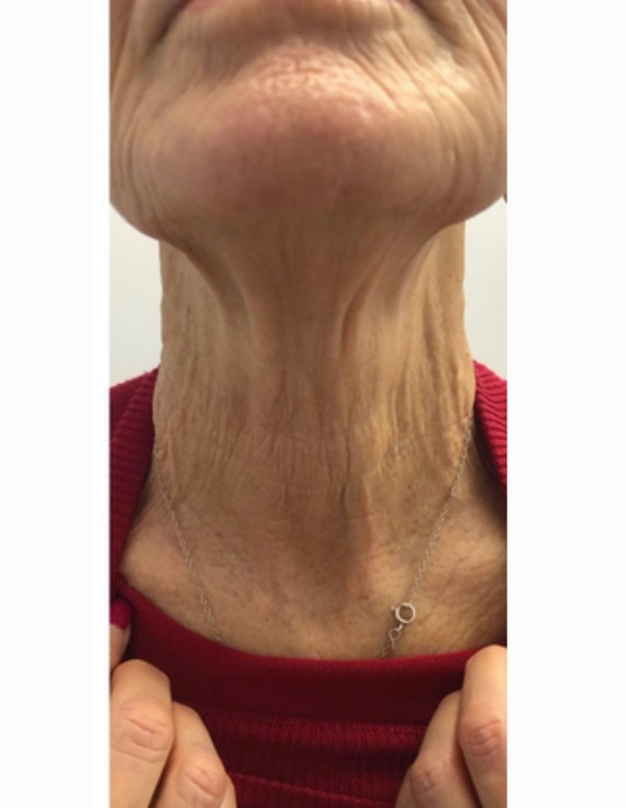 neck-after-w