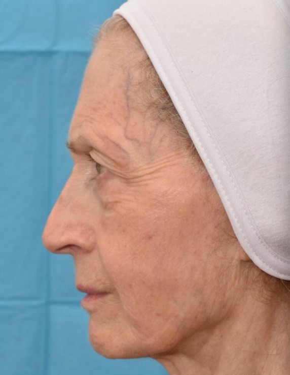 side-face-before-w